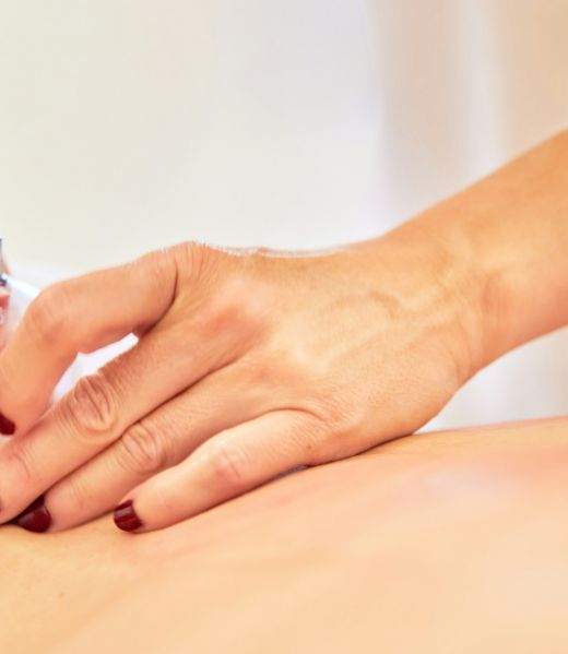 Traditional Vacuum Cupping Therapy in Progress on a Patients Back